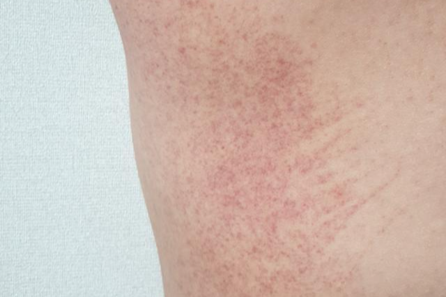 실핏줄의 약한 부위가 점처럼 터지는 점성 출혈이 발생한 모습.