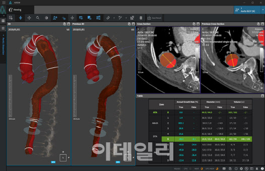 코어라인소프트의 심혈관영상검출·진단보조소프트웨어 ‘에이뷰 에이올타’(AVIEW Aorta) (자료=코어라인소프트)