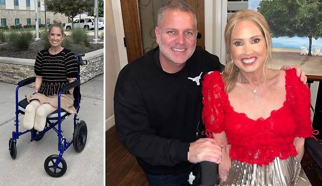 미국의 50대 여성 셰리 무디가 패혈증을 앓고 팔과 다리를 결국 절단했다. 퇴원 후 남편과 셰리(오른쪽사진). 사진=뉴욕포스트