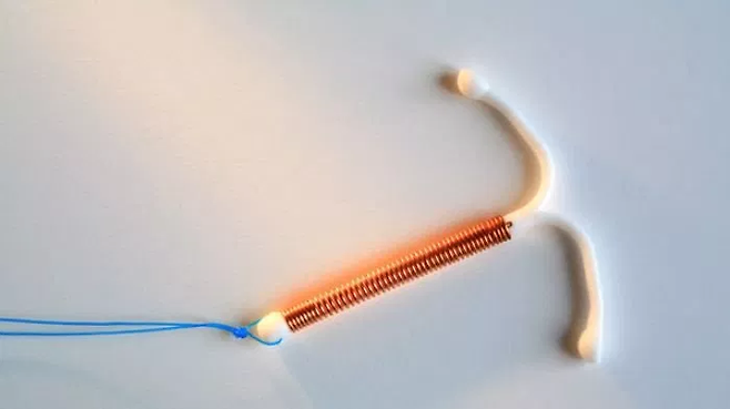 ‘자궁 내 장치’(IUD). 위키피디아