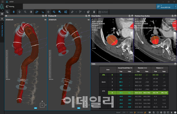 코어라인소프트의 대동맥 박리 진단보조 솔루션 ‘에이뷰 에이올타’(AVIEW Aorta) (자료=코어라인소프트)