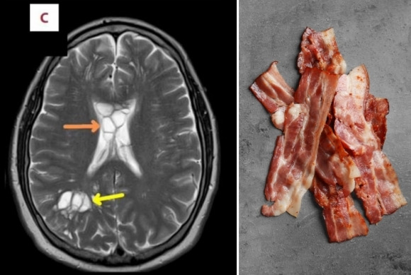 왼쪽은 미국 50대 남성의 뇌 스캔 사진. 화살표 부분은 기생충 감염으로 인해 낭종과 부기가 발생한 부위. 오른쪽은 베이컨 자료사진