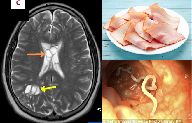   ȣϴ 52    ߰ߵƴ.        ԰ 濡 ƴٴ . [ ȯ  = American Journal of Case Reports /  = Ƽ̹ũ / ϴ =ϸ ĸó]