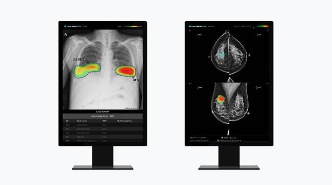 루닛 흉부 엑스레이 AI 영상분석 솔루션 ‘루닛 인사이트 CXR’(왼쪽) 및 유방촬영술 AI 영상분석 솔루션 ‘루닛 인사이트 MMG’./사진 제공=루닛