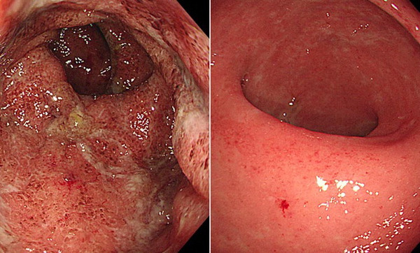 궤양성 대장염에 대한 생물학적 제제 치료 전(왼쪽)과 후의 내시경 사진.