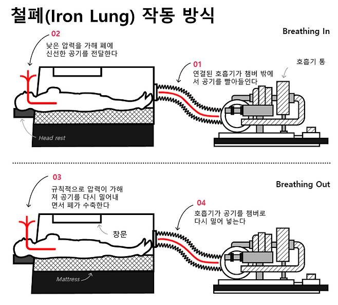 진공 상태가 만들어낸 음압으로 인해 폐가 팽창하고 공기가 다시 흡입되면 압력의 변화로 인해 폐가 부드럽게 수축한다. 기계가 숨을 쉬는 듯한 리드미컬한 작동 소리가 폴의 생명을 유지시켜 준 것이다. [사진 출처_영국 데일리메일 보도 캡처]