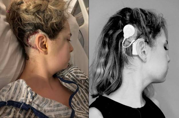 스칼리오네는 신경조직에 종양이 생기는 신경섬유종증 2형 진단을 받았고, 양쪽 귀에 생긴 종양 때문에 청력과 균형에 문제가 생겼다. [사진='뉴욕포스트' 보도내용 캡처, 오른쪽 사진은 청성뇌간이식술 받은 모습]