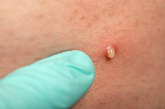 모낭(털집)이 염증을 일으켜 커지면 종기가 된다. 고름이 생기면 조심스럽게 위생적으로 짜낸다. 종기 위에 따뜻하고 축축한 물수건을 매일 수 차례 올려 놓으면 좋다. 몇 주가 지나도 종기가 없어지지 않으면 피부과 전문의 진료를 받아야 한다. [사진= 게티이미지뱅크]