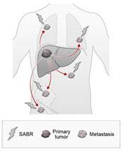 소수 전이성 간암에 시행하는 체부 정위적 방사선치료 원리.