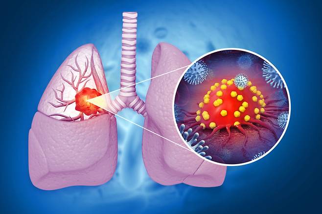폐암이 매우 치명적인 주된 이유는 초기 단계에서 증상이 명확하지 않기 때문이다. 오직 환자 10명 중 1명만이 10년 동안 생존한다. [사진= 게티이미지뱅크]