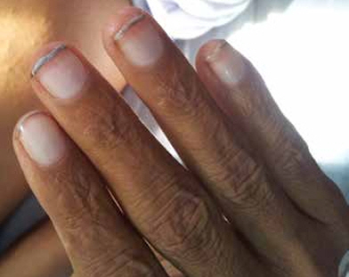 Terry's nail​/사진=Cleveland Clinic Journal of Medicine