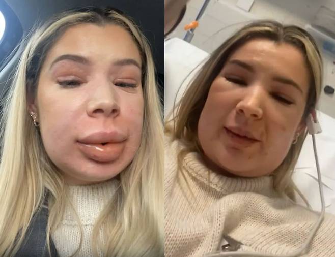 샤나 해리스(24)는 입술에 남아있는 필러를 없애는 시술을 받다가 알레르기 반응이 나타나서 입술, 눈꺼풀, 얼굴이 부었다./사진=더 선