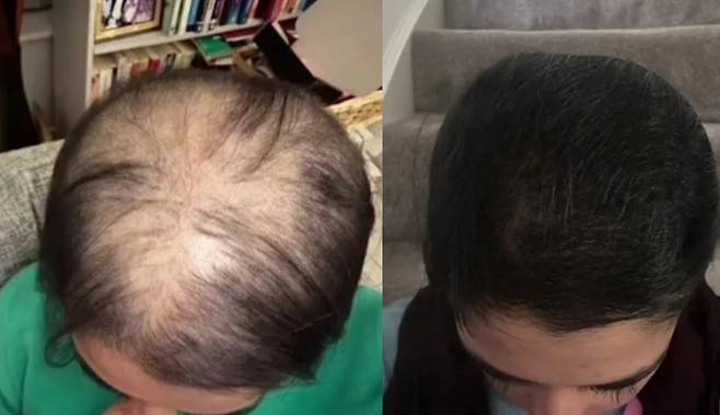한 뷰티 애호가가 자신의 틱톡 계정에 탈모 후 다시 머리카락을 기르는 세 가지 비결을 공개해 화제다. [사진= 영국 일간 더선 보도 캡처 / 출처=파빈 사호타 틱톡@parvsahota5]