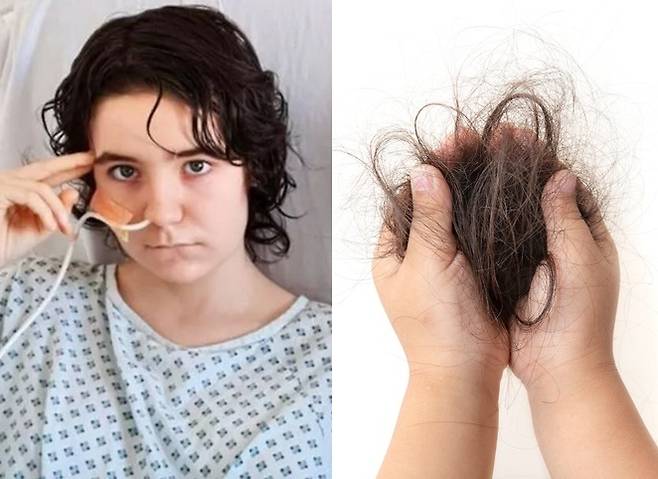 멜리사 윌리엄스는 스트레스로 인해 머리카락을 뽑아 먹는 라푼젤 증후군을 앓았다. (오른쪽은 기사와 직접적 관련없는 자료사진)[사진=리버풀에코(왼)/게티이미지뱅크(우)]