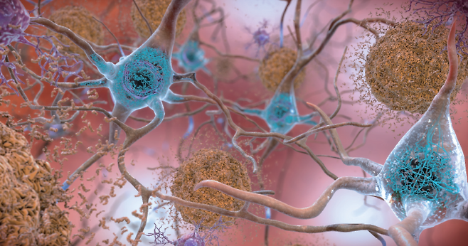 알츠하이머 치매 환자의 뇌에는 아밀로이드 베타 단백질(갈색)이 신경세포에 덩어리를 이루고 있고, 타우 단백질(파란색)도 비정상적으로 뭉쳐있다. 사진 미 국립보건원(NIH)
