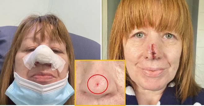 의사마저도 단순 감염된 상처라고만 진단했던 코끝의 붉은 점(하단 사진)이 결국엔 피부암으로 밝혀져 코끝을 절단해야했던 여성의 사연이 공개됐다. 왼쪽이 코끝을 절단 한 후 붕대를 감고 있는 사라의 모습. 오른쪽 점이 계속해서 낫지 않고 피까지 나던 상황의 모습. [사진=영국 일간 더선 보도 캡처]