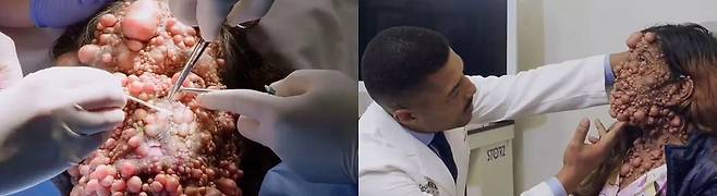 차메인 사헤디오(42)는 ‘신경섬유종증(neurofibromatosis)’ 때문에 피부에 수천 개의 종양이 있다./사진=더 미러