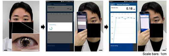 연구진이 스마트 콘택트렌즈를 착용 후 혈당을 재고 있다./사진=해당 연구팀