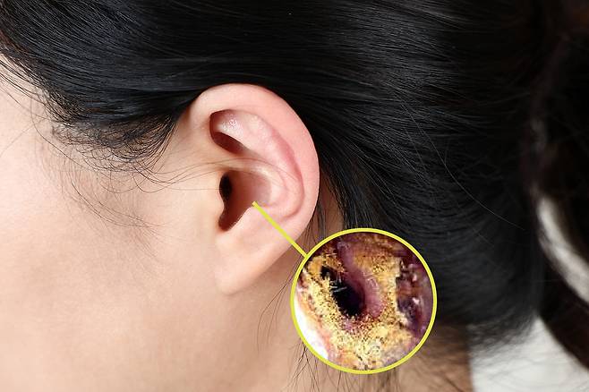 외이도 진균증은 귀 외이도에 아르페르길루스, 칸디다 등과 같은 곰팡이에 감염돼 발생하는 질환이다./사진=클립아트코리아, 대한이비인후과학회​