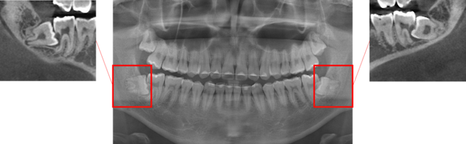 사랑니가 바로 인접한 어금니의 뿌리 부분을 손상시킨 모습. 서울대치과병원 제공