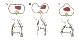 그림 1. A 정상, B 오목가슴 , C 새가슴