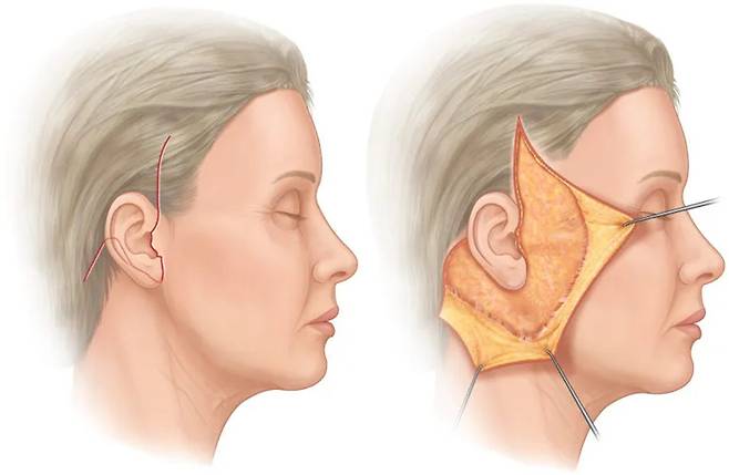 안면거상술(페이스 리프트)은 헤어라인과 귀 앞뒤를 따라 긴 절개를 가해 늘어진 피부와 근막을 잘라내고 당겨서 꿰매는 수술입니다. [그림 출처=Plastic Surgery Key]