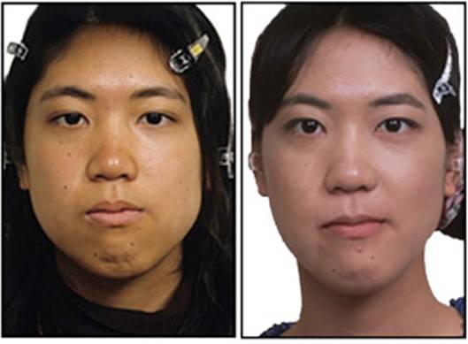 치아를 맞춘다고 해서 안면비대칭이 좋아지지 않습니다.[사진= (Am J Orthod Dentofacial Orthop 2016;150:1028)]