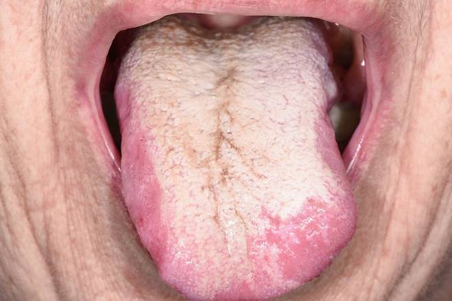 혀 색깔로 건강 상태를 확인해 볼 수 있다./사진=클립아트코리아