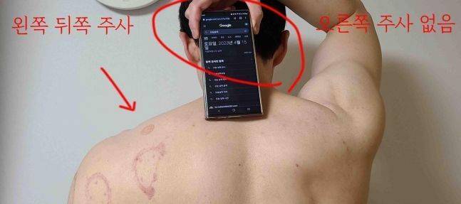 환자에게 왼쪽 어깨에만 주사를 놓고도 병원은 양쪽 어깨에 주사를 놓은 것으로 진료기록을 작성해 건보료를 신청했다. [사진출처=연합뉴스]