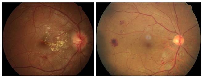 고혈압망막병증 환자의 안저사진(왼쪽)과 당뇨망막병증 환자의 안저사진. 사진제공=김안과병원