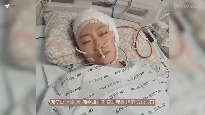 불의의 사고로 왼쪽 머리뼈 일부를 절개하는 수술을 한 우은빈 씨. [유튜브 채널 '우자까' 캡쳐]