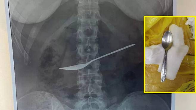 지속적인 복통에 병원을 찾은 러시아 소녀의 뱃속에서 약 20cm 쇠숟가락이 발견됐다. [사진=영국 매체 더미러/Newsflash]