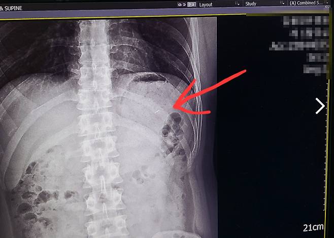 An X-ray image showing what is claimed to be a metal pin (Bobaedream)