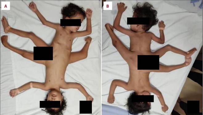 골반 부분에서 서로 붙은 채 태어난 쌍둥이가 있다. [사진 출처=American Journal of Case Reports]
