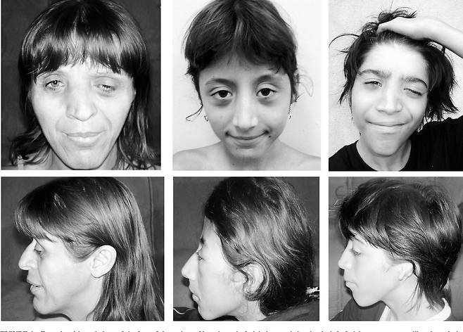세이트리 챠즌 증후군 환자들은 두 눈 사이가 심하게 벌어지고, 눈이 튀어나오거나 눈꺼풀이 처진 안검하수가 나타나기도 한다.​/사진=The Cleft Palate-Craniofacial Journal