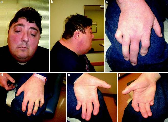 세이트리 챠즌 증후군은 환자에 따라 엄지손가락이 비정상적으로 크거나, 발가락이 크고 손가락이 짧은 모습도 보인다​./사진=Atlas of Genetic Diagnosis and Counseling