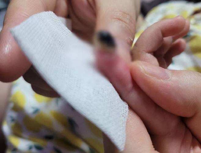사고로 손가락이 절단됐다면, 즉시 주변 병원을 방문해 수술받아야 한다./사진=조선일보DB