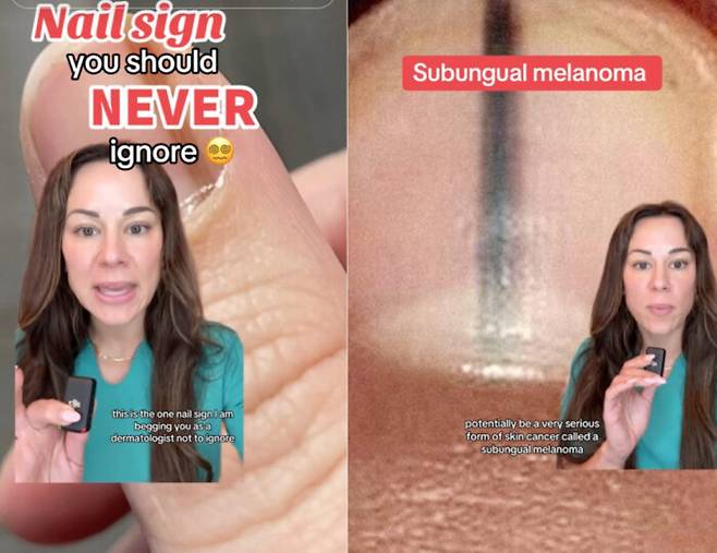 미국 미시시피주의 한 피부과 전문의 린지 주브릿스키 박사는 손톱에 검은 세로 줄이 생기면 손발톱밑 흑색종을 의심해볼 수 있다고 조언했다. [사진=미국 일간 뉴욕포스트 캡처/틱톡 'dermguru']