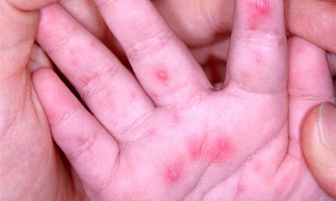 수족구병에 걸린 아이의 손. 질병관리본부 제공