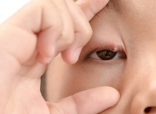 다래끼에서 노란 알갱이 같은 염증이 보이거나, 마이봄샘이 막혀 생긴 콩다래끼일 때는 병원에 가는 게 좋다./사진=게티이미지뱅크