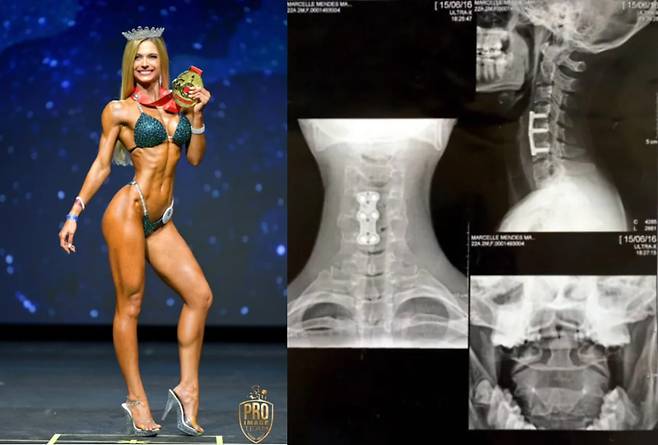 척추가 부러지는 끔찍한 사고를 당한 후 다시는 걸을 수 없을지도 모른다는 말을 들었던 한 여성 변호사가 보디빌더 챔피언이 된 사연이 화제다. 오른쪽 사진이 사고 당시 부러진 경추의 모습 [사진=영국 일간 더선 보도 갈무리]