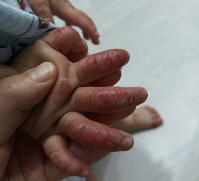 중증 아토피 피부염을 앓고 있는 3세 아이의 손가락 모습/사진= 3세 아이 아버지 안진욱씨