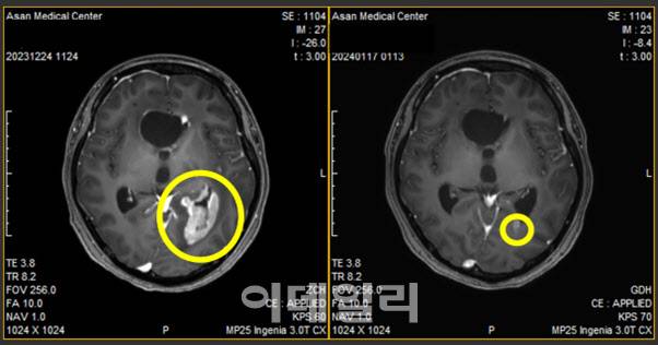 바바메킵 처리 전·후 교모세포종 환자의 뇌 MRI 이미지. (제공=에이비온)