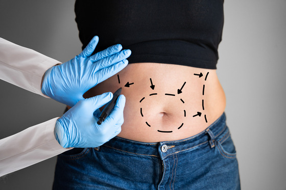 Pictured is a surgeon marking a patient for liposuction, unrelated to the story. [SHUTTERSTOCK]