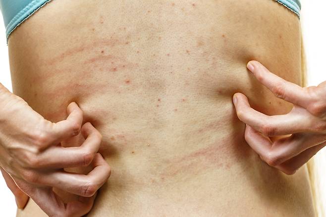 ​땀띠는 가려워도 긁지 말고, 시원한 환경을 만들어주는 게 좋다​./사진=게티이미지뱅크
