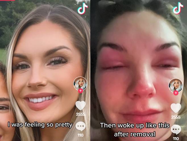 속눈썹 연장술을 수년간 즐겨 받던 한 여성이 최근 이 시술을 받고 난 후 눈이 진드기에 감염돼 알레르기 반응을 일으킨 증상을 틱톡에 공유했다. [사진=여성의 틱톡 캡처, 데일리메일 보도 사연]