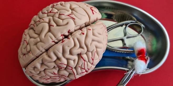 영국의 10대 환자가 세계 최초로 뇌전증 발작을 억제하기 위한 뇌내 이식술을 받았다. 게티이미지뱅크