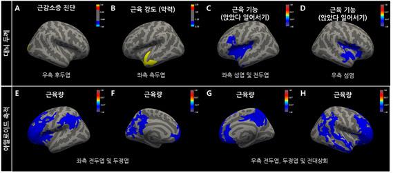 근감소증 진단(A)과 달리 근육 강도가 약할수록 왼쪽 측두엽 위축(B), 근육 기능이 떨어질수록 양측 섬염 위축이 심했다(C). 반면 근육량이 많을수록 양측 전두엽과 두정엽의 아밀로이드-베타 단백질 축적이 적었다. 여의도성모병원 제공