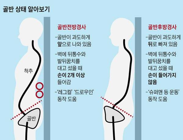 두 손이 다 들어가면 앞쪽으로 골반이 틀어진 ‘골반전반경사’이다. 손이 아예 들어가지 않으면 ‘골반후반경사’를 의심할 수 있다./사진=헬스조선DB