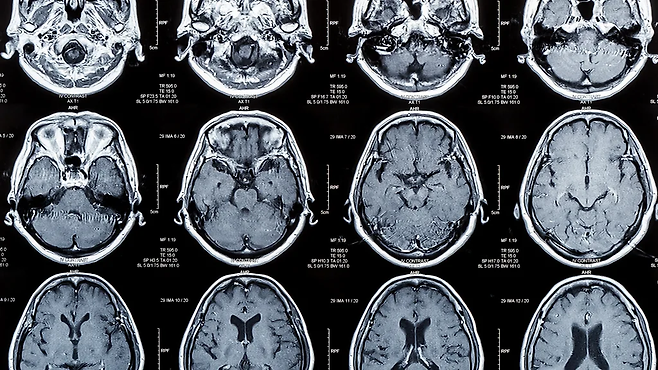인간의 뇌는 노화로 인해 다양한 변화를 겪는다